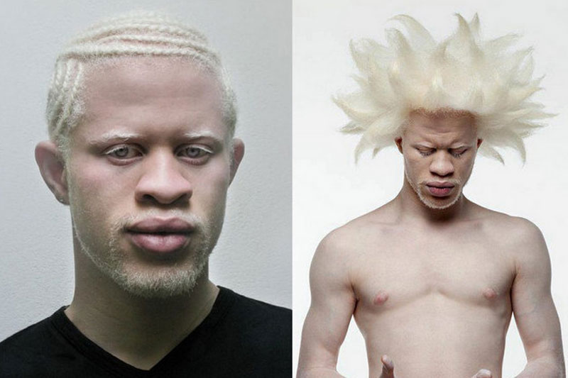 You’ve all probably heard about the syndrome of albinism.