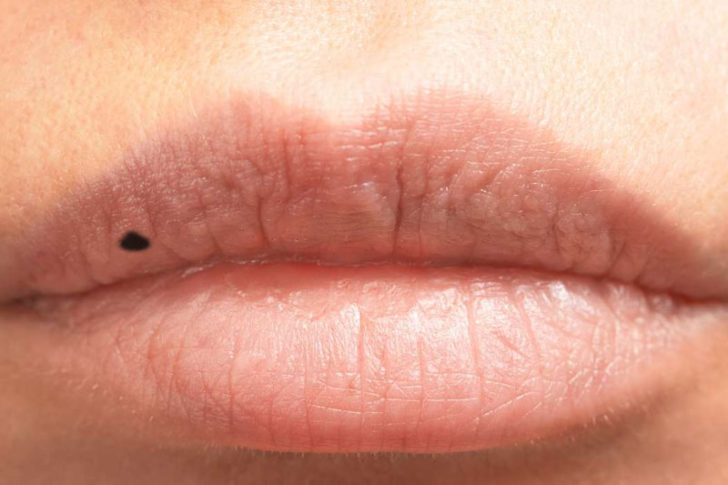 black-spot-on-bottom-lip