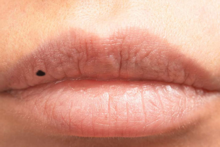 Don't Ignore These 10 Health Warning Signs Your Lips are Telling You