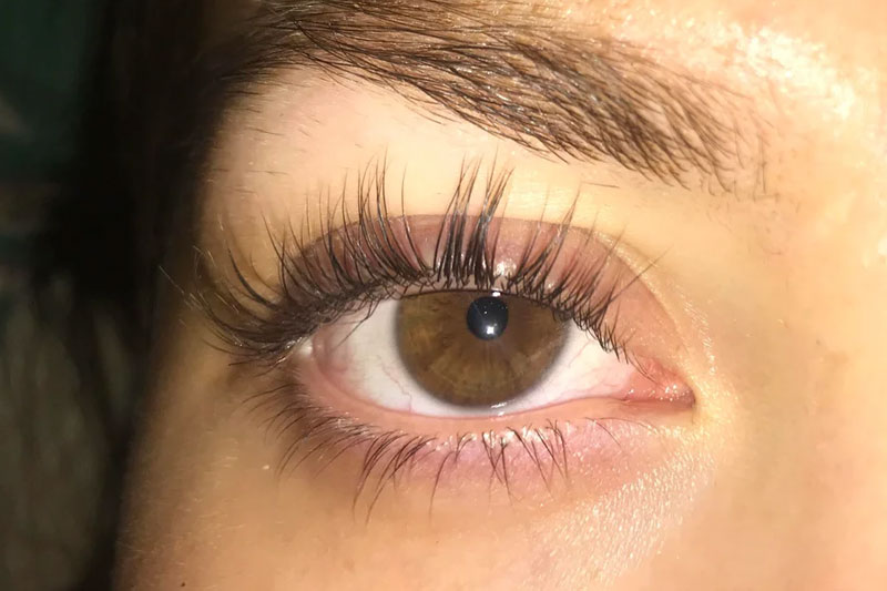 Distichiasis or double eyelashes