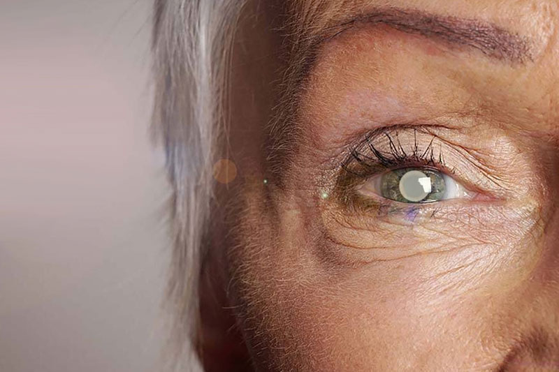 Elderly Women With Cataracts (But Not Men) Have Higher Mortality Rate