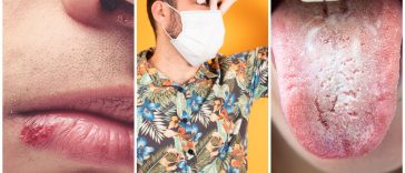 5 New Side Effects of Face Masks And How To Treat Them