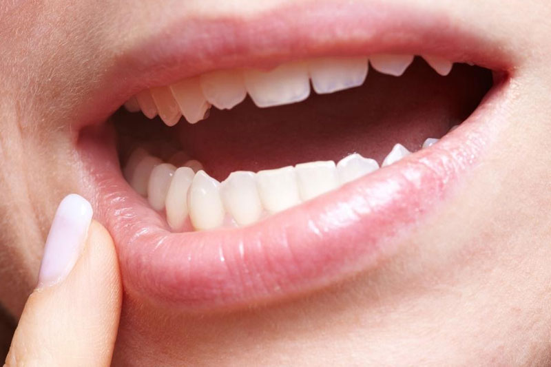 Don't Ignore These 10 Health Warning Signs Your Lips are Telling You