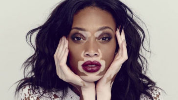 Vitiligo