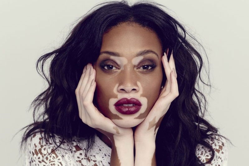 Vitiligo