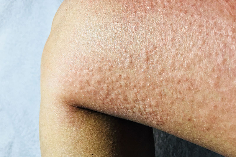 Cold Urticaria