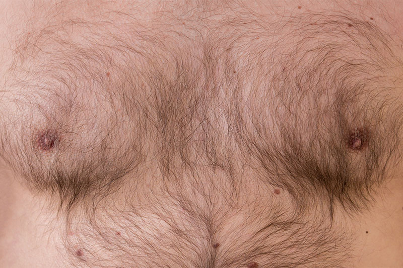 Hypertrichosis body hair