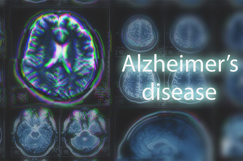 Can Alzheimer's Be Stopped? 9 Lifestyle Changes Can Help Prevent Alzheimer’s Disease