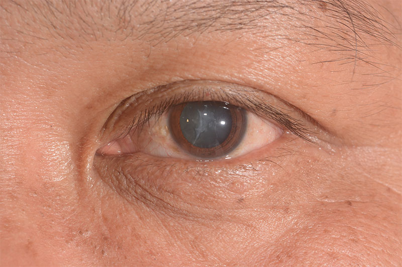 close up of the senile cataract during eye examination, mature cataract, neuclear sclerosis cataract.
