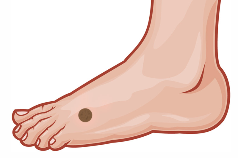 foot melanoma