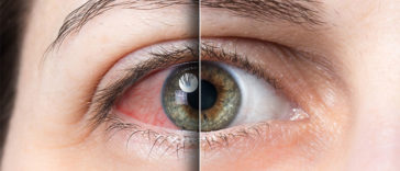 Tired Eyes? 10 Home Remedies That May Actually Work