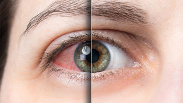 Tired Eyes? 10 Home Remedies That May Actually Work