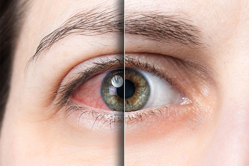 Tired Eyes? 10 Home Remedies That May Actually Work