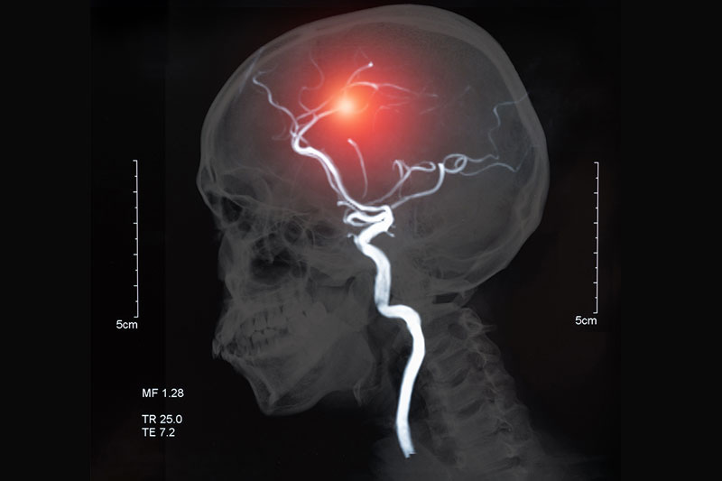 What is a Mini stroke?