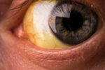 A Thick Yellow Eye Gunk Shows Infection