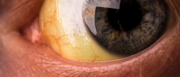 A Thick Yellow Eye Gunk Shows Infection