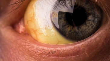 A Thick Yellow Eye Gunk Shows Infection