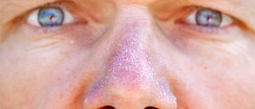 How Can You Treat A Dry Nose?