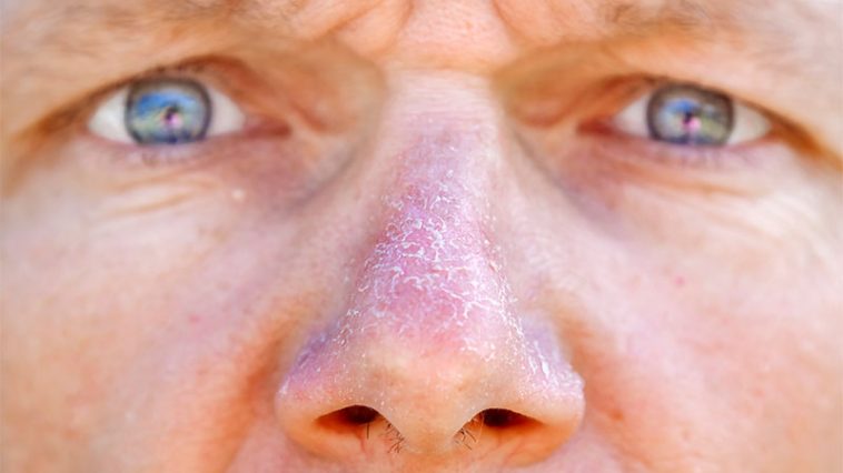How Can You Treat A Dry Nose?