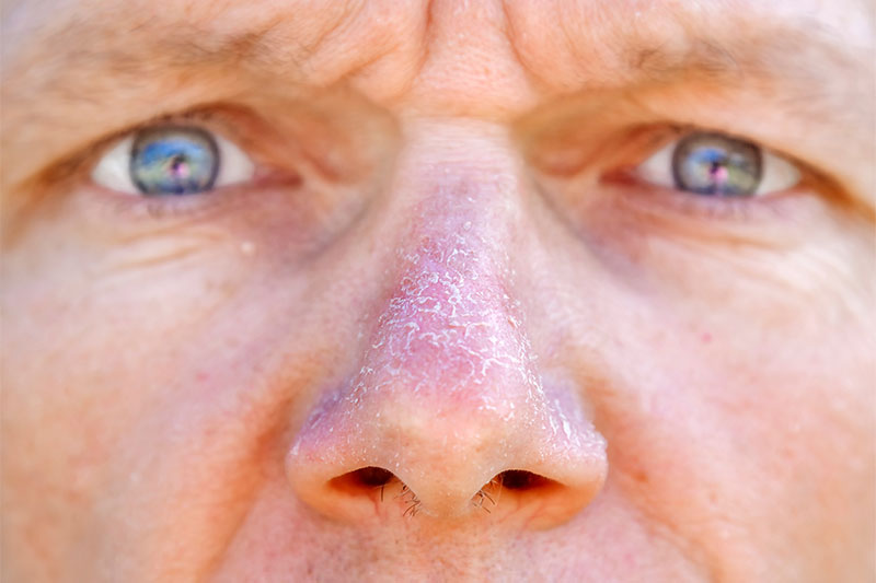 How Can You Treat A Dry Nose?