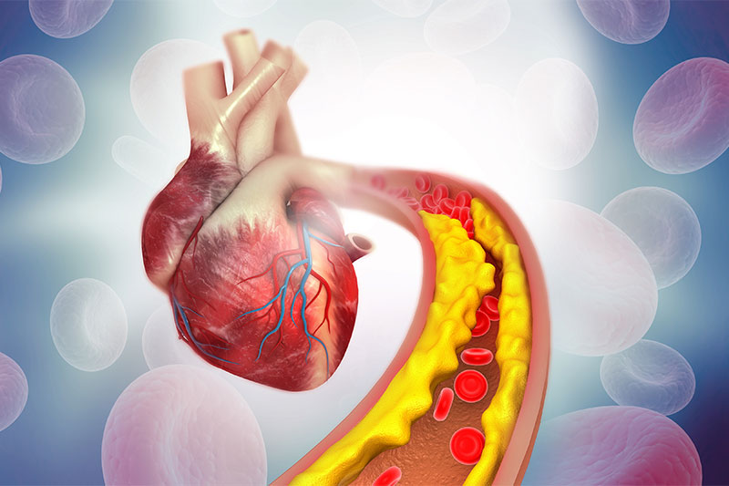 Cholesterol plaque in artery with Human heart anatomy