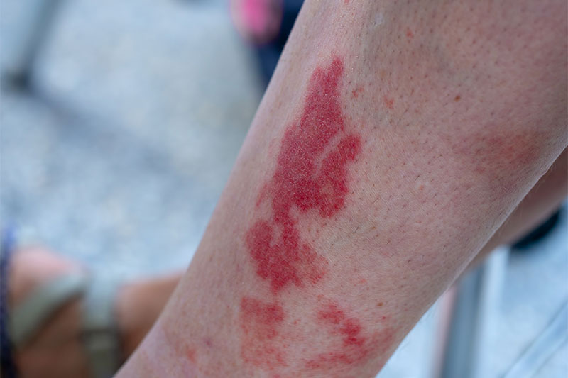 Your Rash Appears Suddenly Like Bruise-Like Lesions