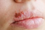Don't Ignore These 10 Health Warning Signs Your Lips are Telling You