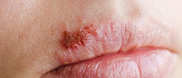 Don't Ignore These 10 Health Warning Signs Your Lips are Telling You