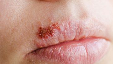 Don't Ignore These 10 Health Warning Signs Your Lips are Telling You