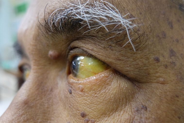 12 Warning Signs Of Nonalcoholic Fatty Liver Disease Page 2 of 14