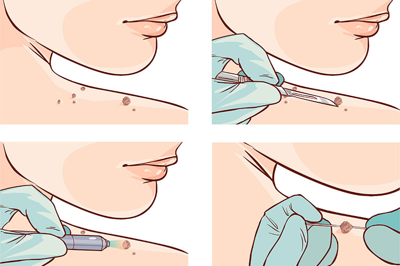 Mole Removed surgery