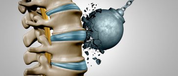 How to Find Out if Your Bones Are as Strong as They Should Be