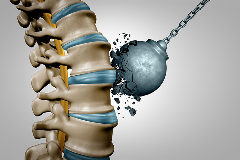 How to Find Out if Your Bones Are as Strong as They Should Be