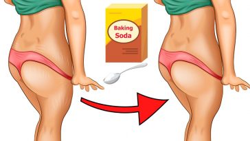 Stretch marks baking soda