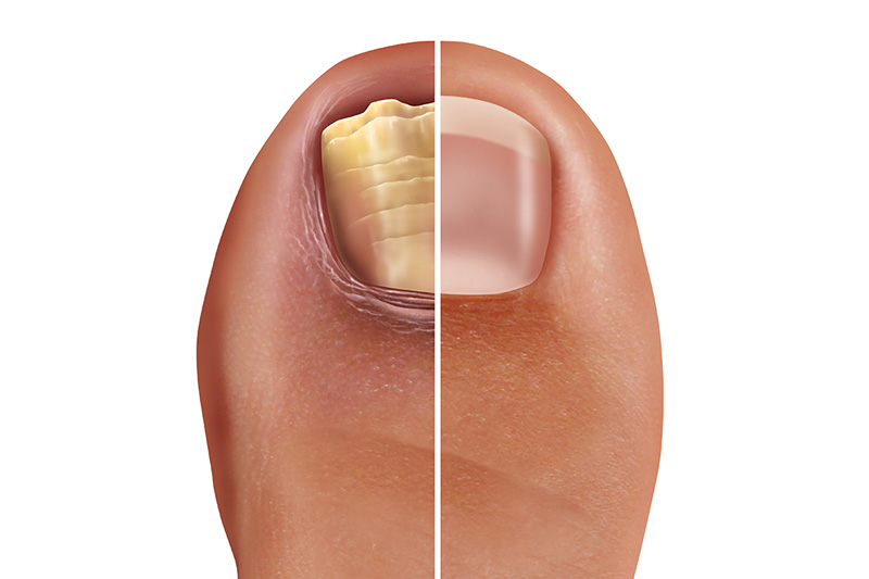 Your Nails are Getting Thick and Yellow  Fungal nail infection and onychomycosisor tinea unguium as an infected foot toenail or toe nail with damaged unhealthy and healthy human