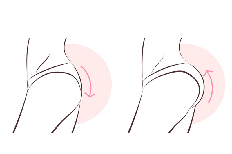 Butt Lift Procedure