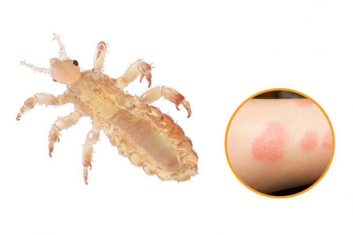 12 Bug Bites Anyone Should Be Able To Identify Factspedia 12 Bug Bites Anyone Should Be Able To Identify Factspedia