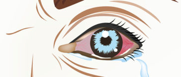 Conjunctivitis