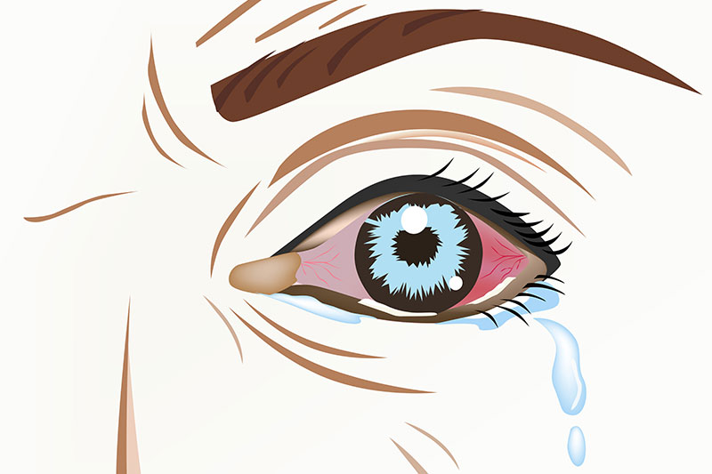 Conjunctivitis (Pinkeye) :The conjunctiva is the thin clear tissue that lies over the white part of the eye and lines the inside of the eyelid.