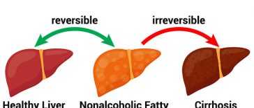 10 Warning Signs Of Nonalcoholic Fatty Liver Disease