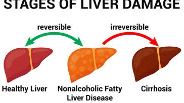 10 Warning Signs Of Nonalcoholic Fatty Liver Disease