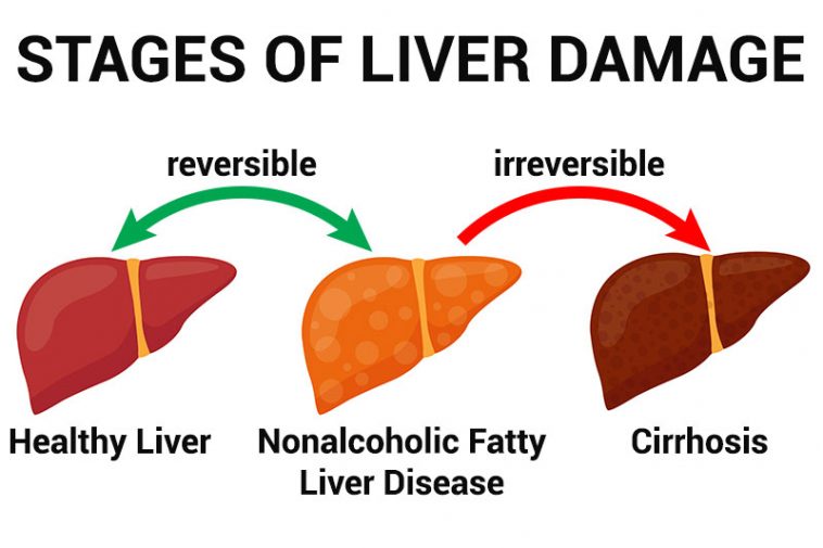 12 Warning Signs Of Nonalcoholic Fatty Liver Disease - Factspedia