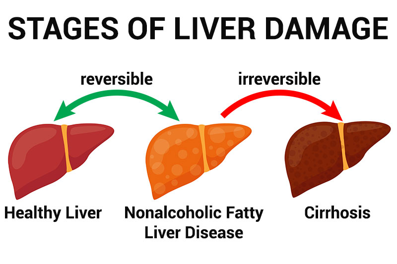 10 Warning Signs Of Nonalcoholic Fatty Liver Disease