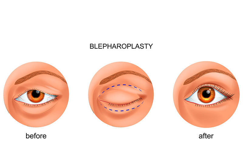 Eyelid Lift blepharoplasty