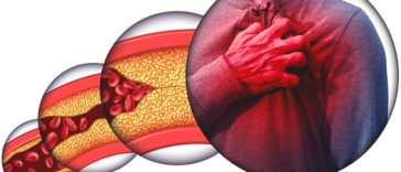 7 Dangerous Signs of Blocked Arteries We Often Ignore
