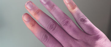 5 Unwanted side effects of poor blood circulation in the body