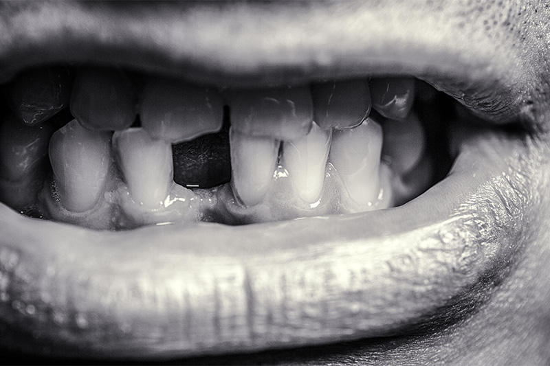 The link between teeth loss and cardiovascular diseases