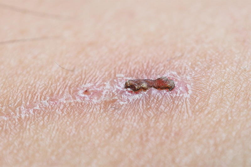 Closeup of wound forming a scab after the skin was cut and bled.