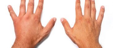 What Does It Mean When Your Hands Swell?