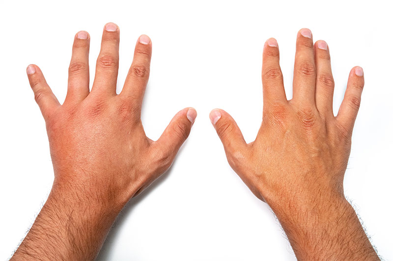 What Does It Mean When Your Hands Swell?